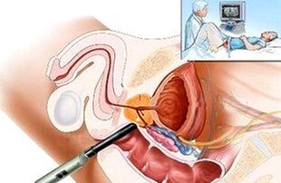Ways to diagnose prostatitis