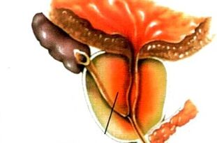 What is prostatitis in men