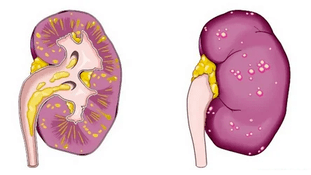 What causes acute prostatitis