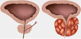 What is prostatitis