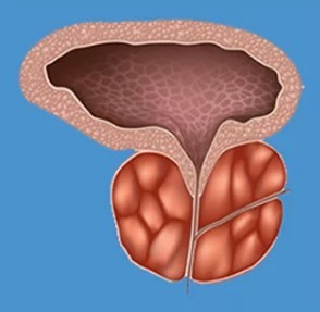 The typical symptoms of prostatitis