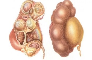 Vesiculitis