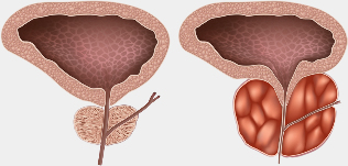 healthy and unhealthy glands