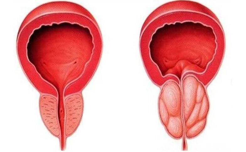 healthy and inflamed prostate with prostatitis