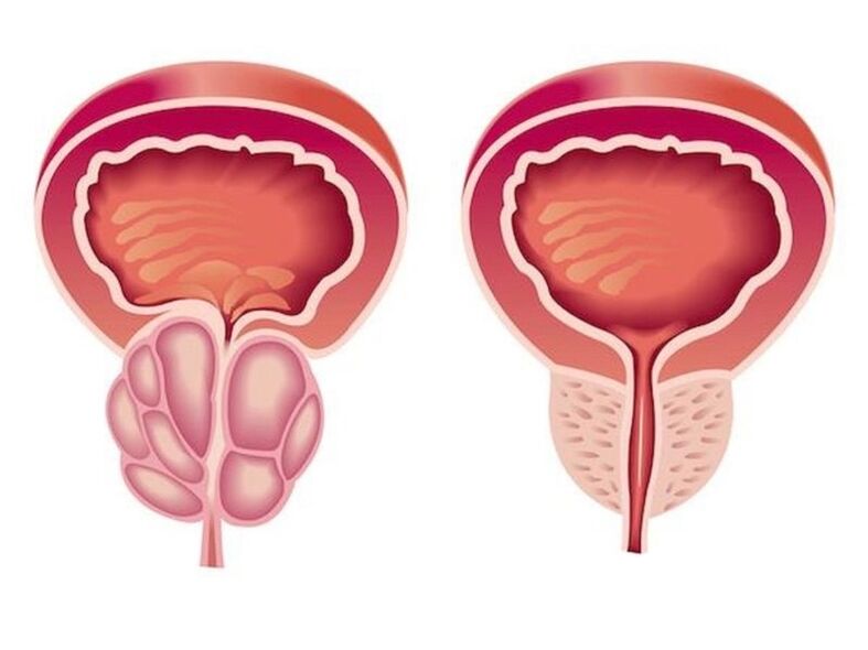 prostatitis